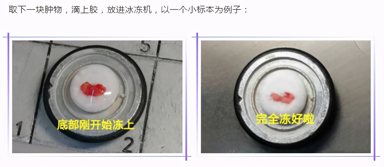 肿瘤防治科普视频,肿瘤冷冻切片和病理哪一个准确