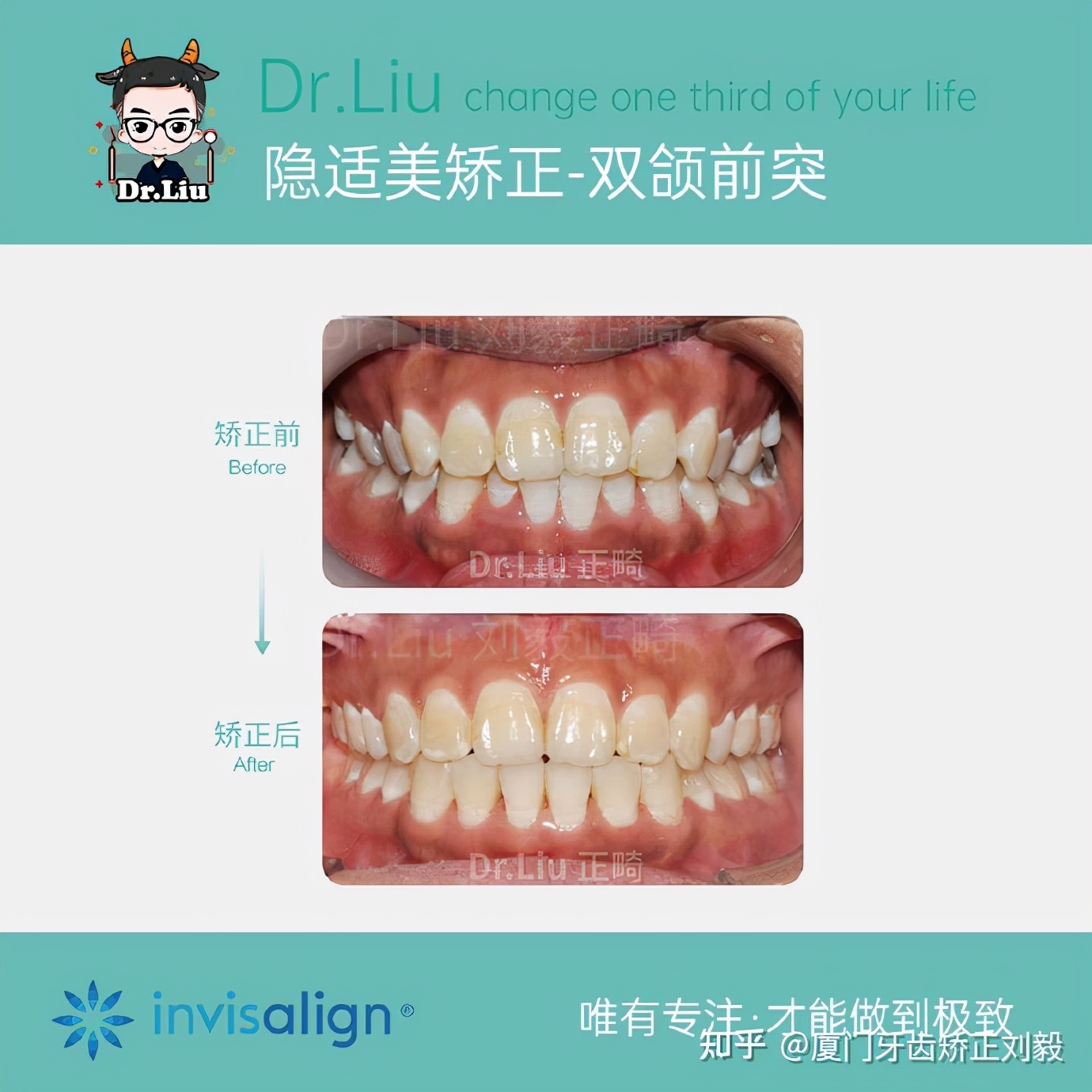 厦门成年人牙齿舌侧矫正,下嘴唇厚且外翻牙齿矫正