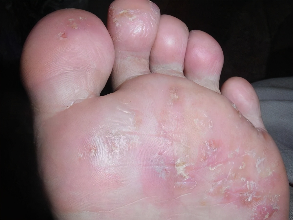 脚气发作难忍,脚气奇痒是什么原因