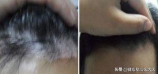 生姜擦头脱发更严重了,生姜煮水洗头能治疗脱发吗