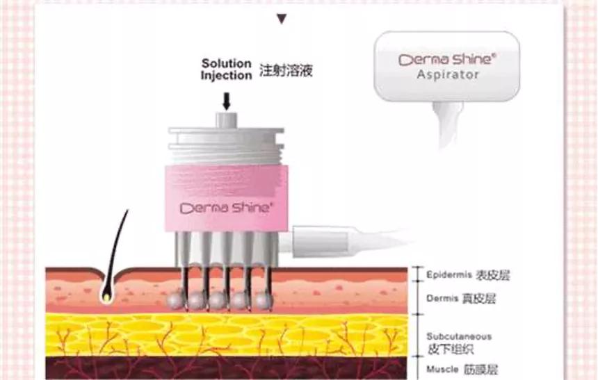 《美容针》简介,美容针知识大全