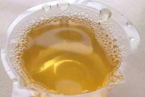 小便提醒肾出问题,小便三个表现说明尿酸已经高了吗