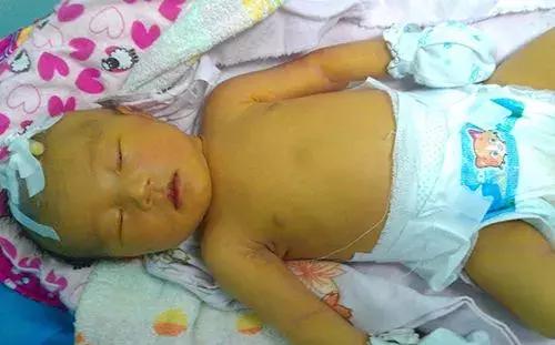 黄疸治疗不及时,宝宝居然会脑瘫?