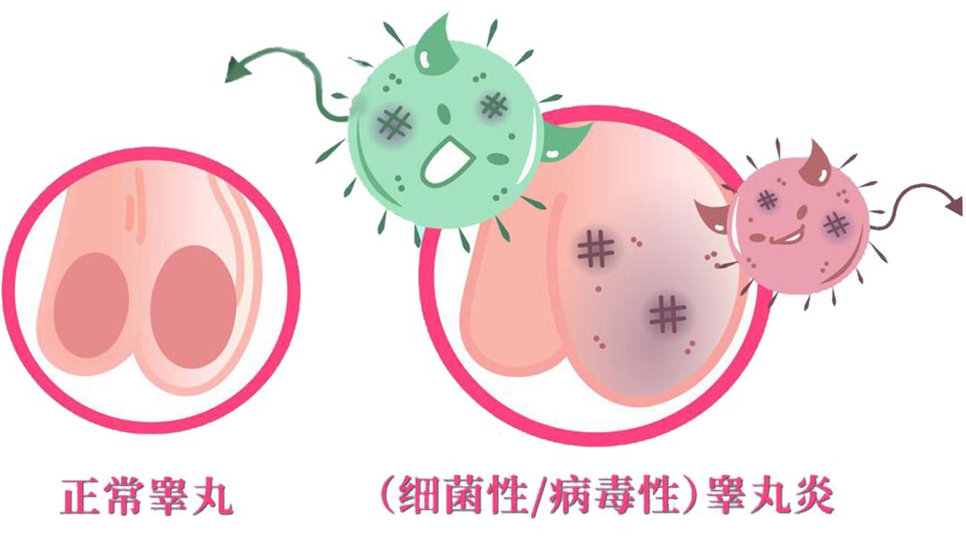 男性生殖感染疾病有哪些,男性夏季如何预防泌尿感染