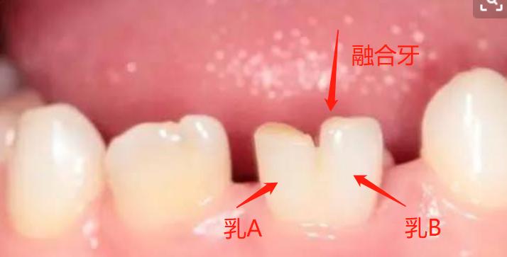 宝宝出牙口腔护理操作,宝宝出牙时期护理技巧大全