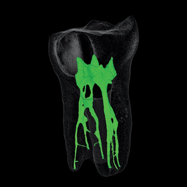 牙疼治死牙神经可以吗,什么药治牙疼牙神经效果最好