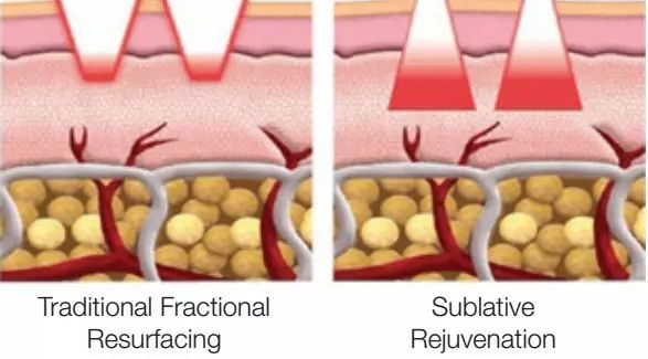 最有效祛痘疤方法,祛痘疤最有效的方法学生