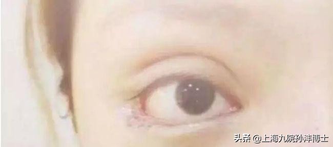孙沣眼修复有成功案例么,眼修复能找原来医生修复吗