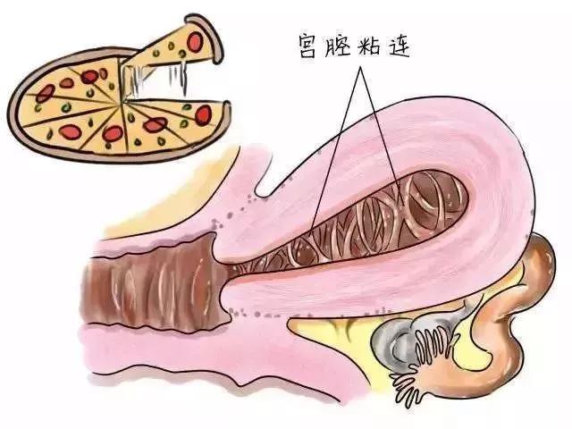 对宫腔粘连存在的疑问,宫腔粘连医生说不影响怀孕为什么