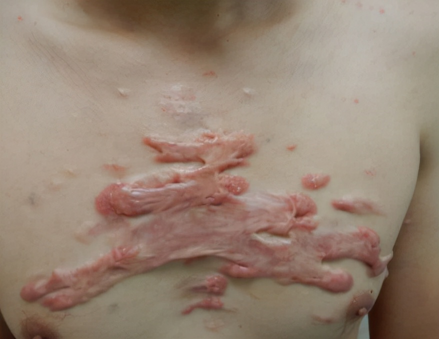 凸起增生疤痕怎么变平,疤痕增生凸起涂什么药