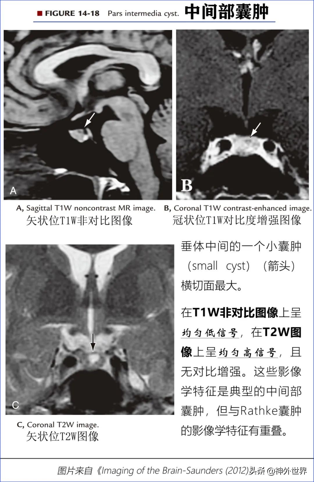 鞍区核磁解剖图,鞍区解剖与手术