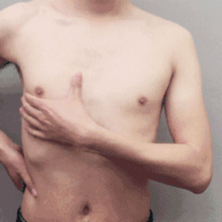 男生的左胸为什么比右胸大,男生胸大是有什么问题吗