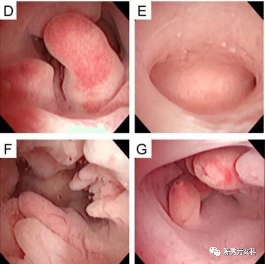 王熙凤血崩是怎么回事,王熙凤的血山崩原因
