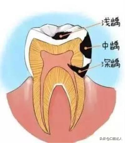 补牙为什么不能一次完成,蛀牙补牙需要几次才能完成