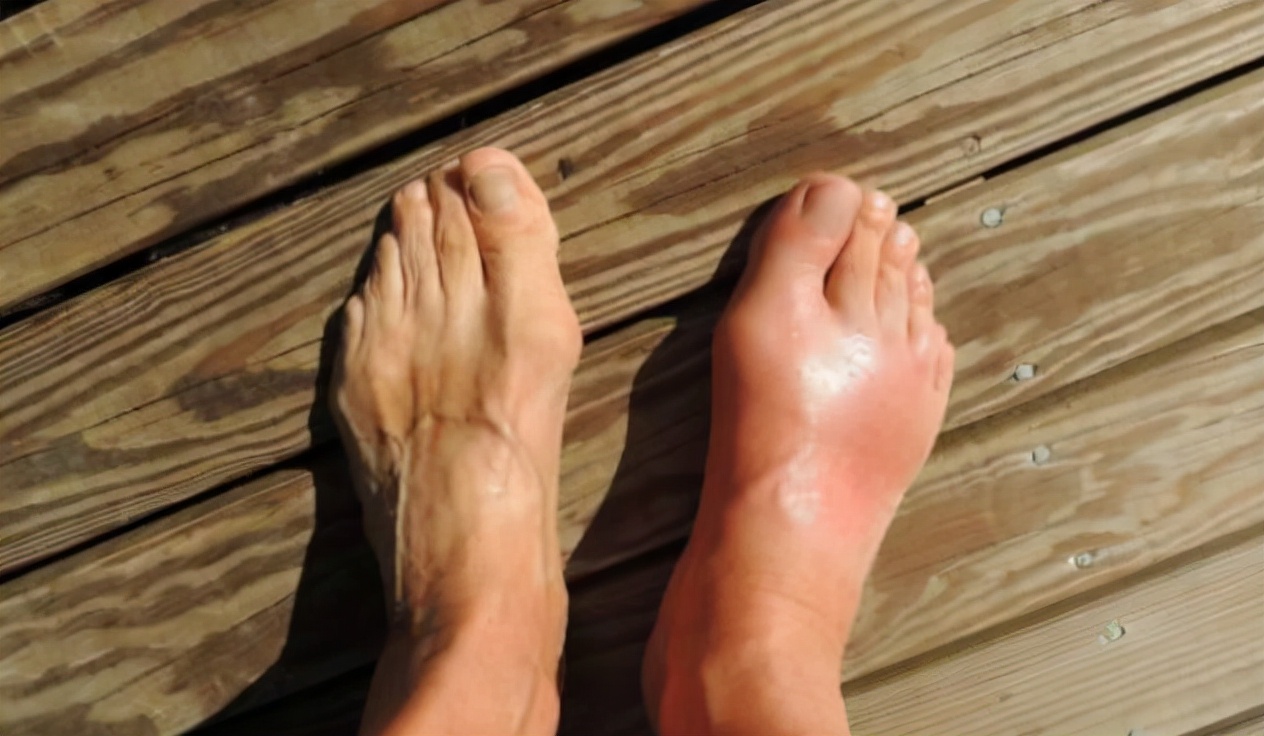 痛风为什么会发作导致关节疼,痛风急性发作怎么缓解关节疼痛