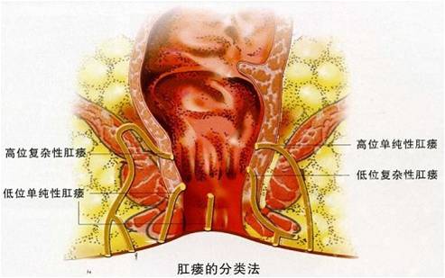 肛瘘手术比生孩子还痛吗,做完肛瘘手术疼痛怎么解决