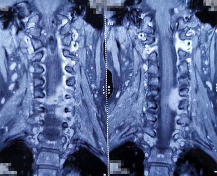 因颈背部疼痛、上臂抽疼，检查出颈5椎体结核