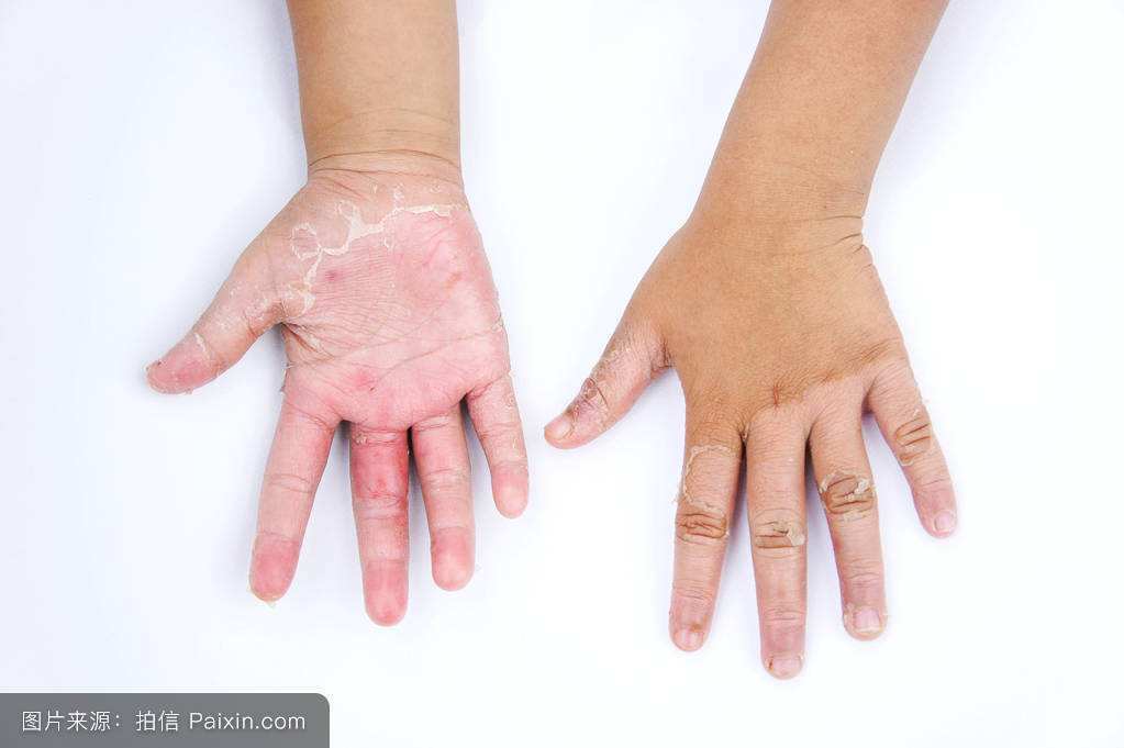 手指每年春天就起泡脱皮怎么治疗,手指起泡脱皮是什么原因