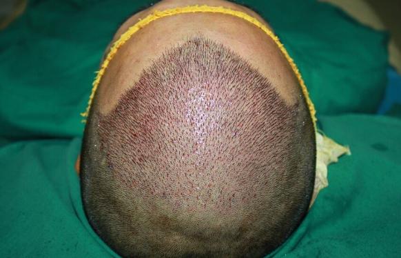 二十八岁头发开始秃有救吗,二十八岁头发掉光