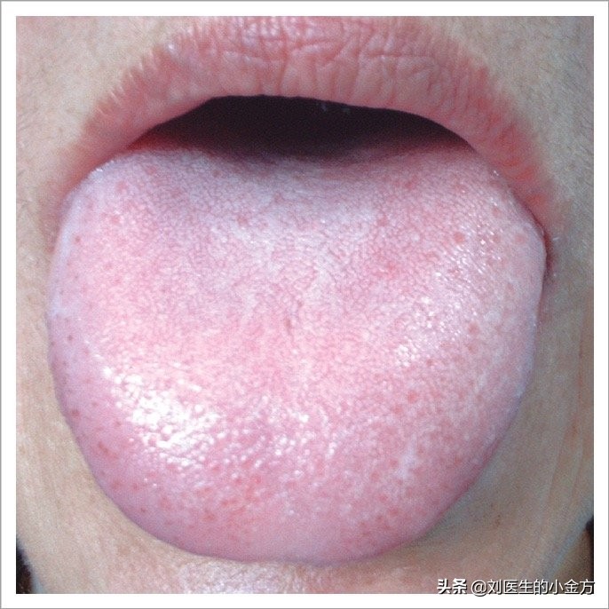 中医舌诊对照表100例,舌诊辨九大体质