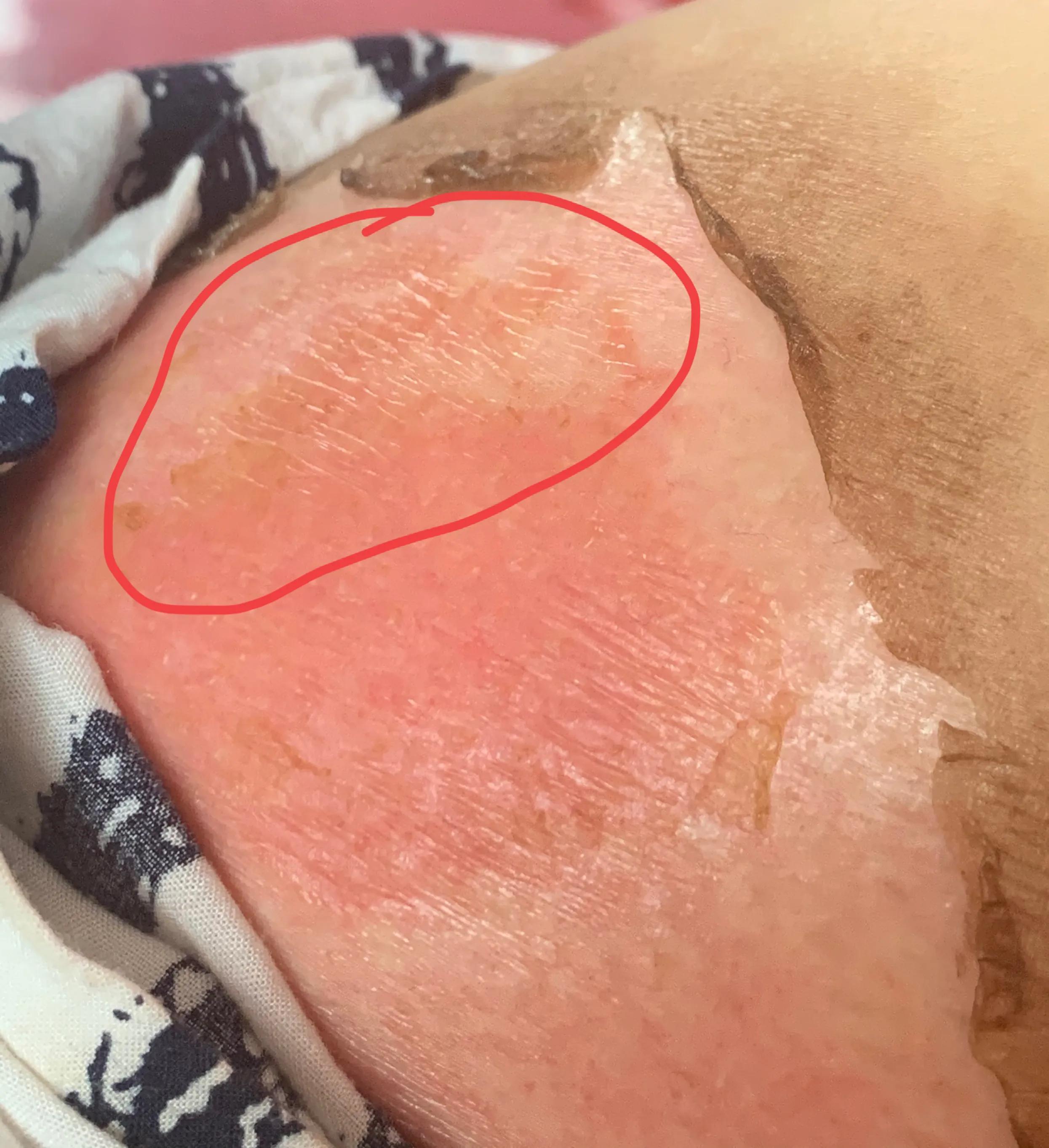 浅二度烫伤14天恢复图片,宝宝浅二度烫伤多久能恢复正常