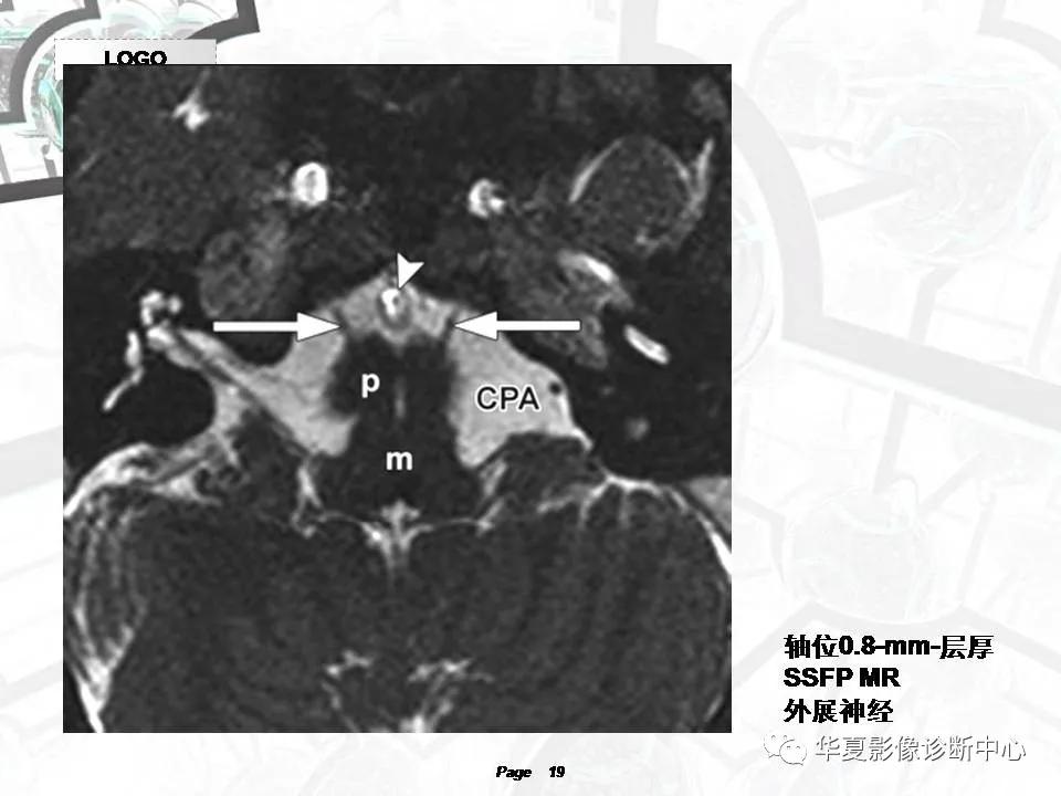 磁共振颅神经扫描是定位在哪,颅神经图谱