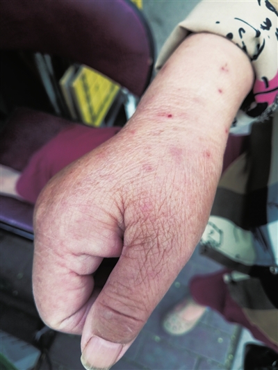 银川德胜一区多位居民遇咄咄怪事:身上起红疹,奇痒无比