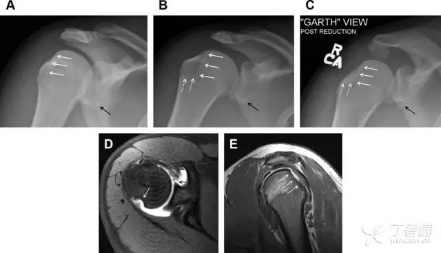 常见的八种骨折,容易漏诊的肩关节骨折