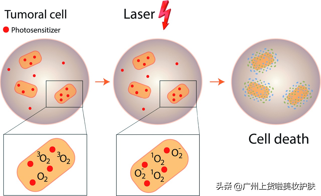 paa美容抗衰和光子嫩肤哪个好,美容光子嫩肤有什么作用