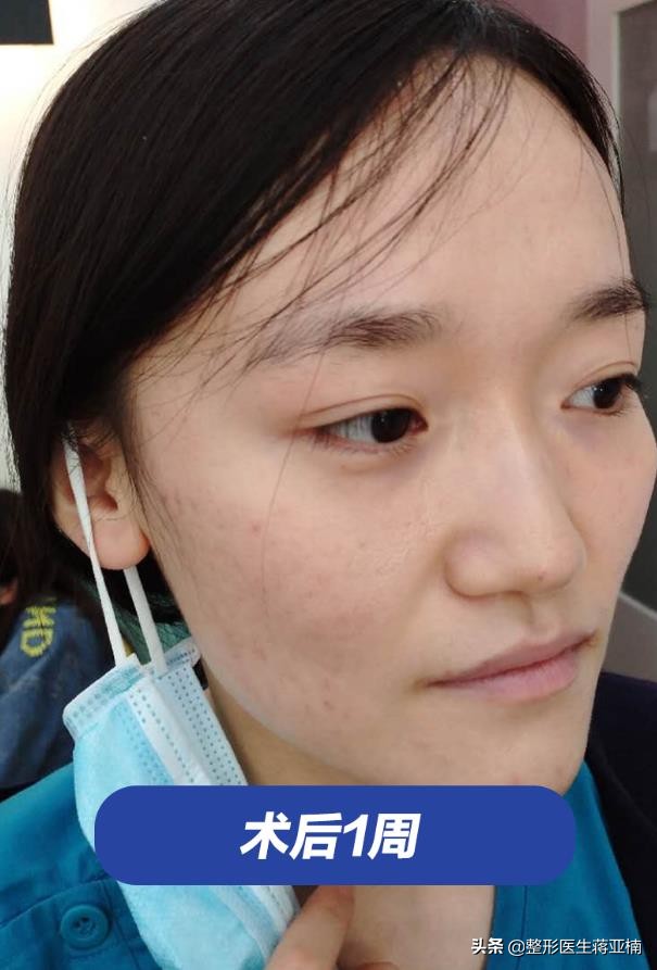 青春不留痘祛痘效果好吗,青春不长痘