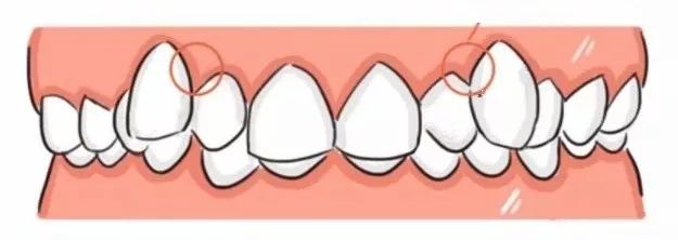 牙龈里的黑东西是什么,牙龈间有黑东西怎么办