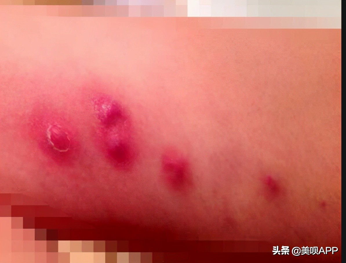 医美注射常识基础知识,医美注射风险