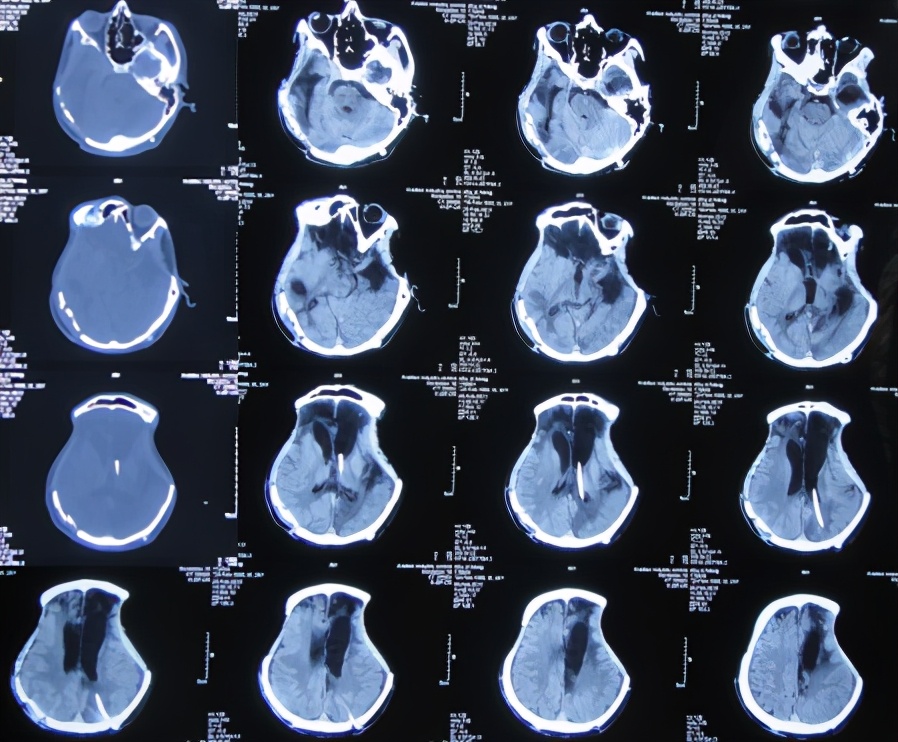脑受伤开颅手术昏迷,开颅手术后20天发生脑积水引流