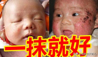 哪种湿疹膏好用,一搽灵药膏对湿疹有效吗