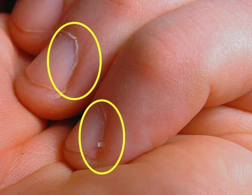 指甲有竖条纹是大病的前兆吗,指甲出现褐色竖纹代表什么病
