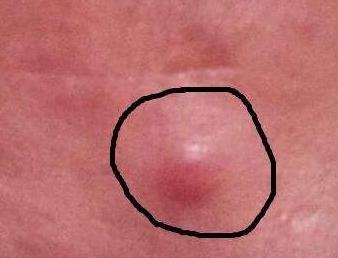 教你4个祛痘印最有效的方法,怎么去痘印最快最有效最简单