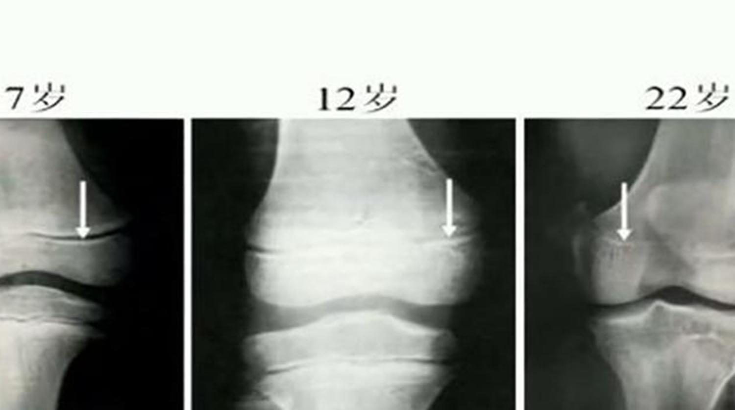 补钙对青少年长高有帮助吗,长高吃钙片和喝奶粉补钙哪个好