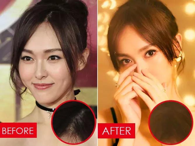 拯救发际线告别大额头,拯救发际线不走冤枉路