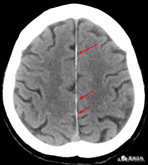 蛛血的临床表现,蛛血ct表现