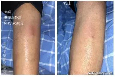 静脉炎的预防和处理应急预案,静脉炎的预防及处理文献