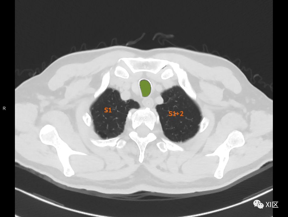 如此详细的肺部影像解剖，有点儿酷