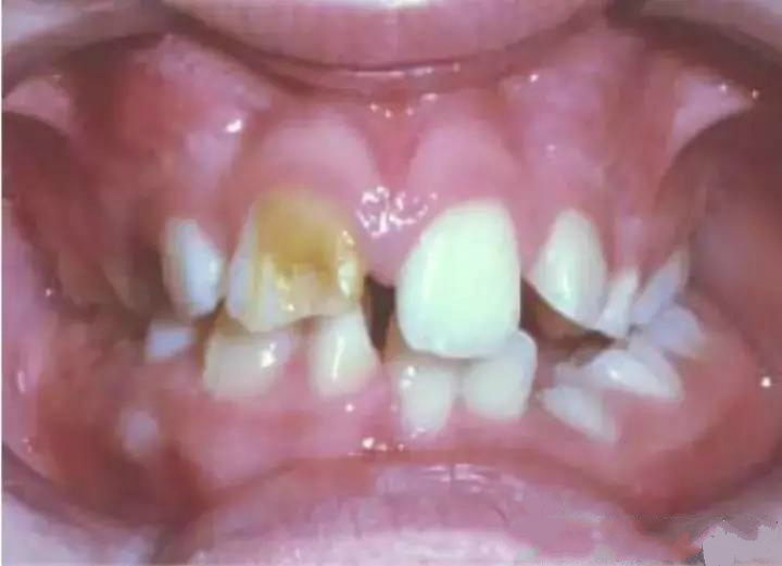 小黑点的蛀牙不严重吗,蛀牙了一点点黑色也得补么