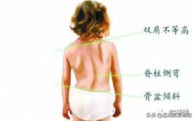 沉肩的时候肩胛骨下角翘起怎么办,肩胛骨翘起真的可以改善吗