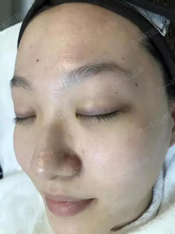 祛痘医美项目真实效果,祛痘印的医美项目对比