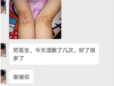 中医解释湿疹痒的原因,皮肤起湿疹怎么办