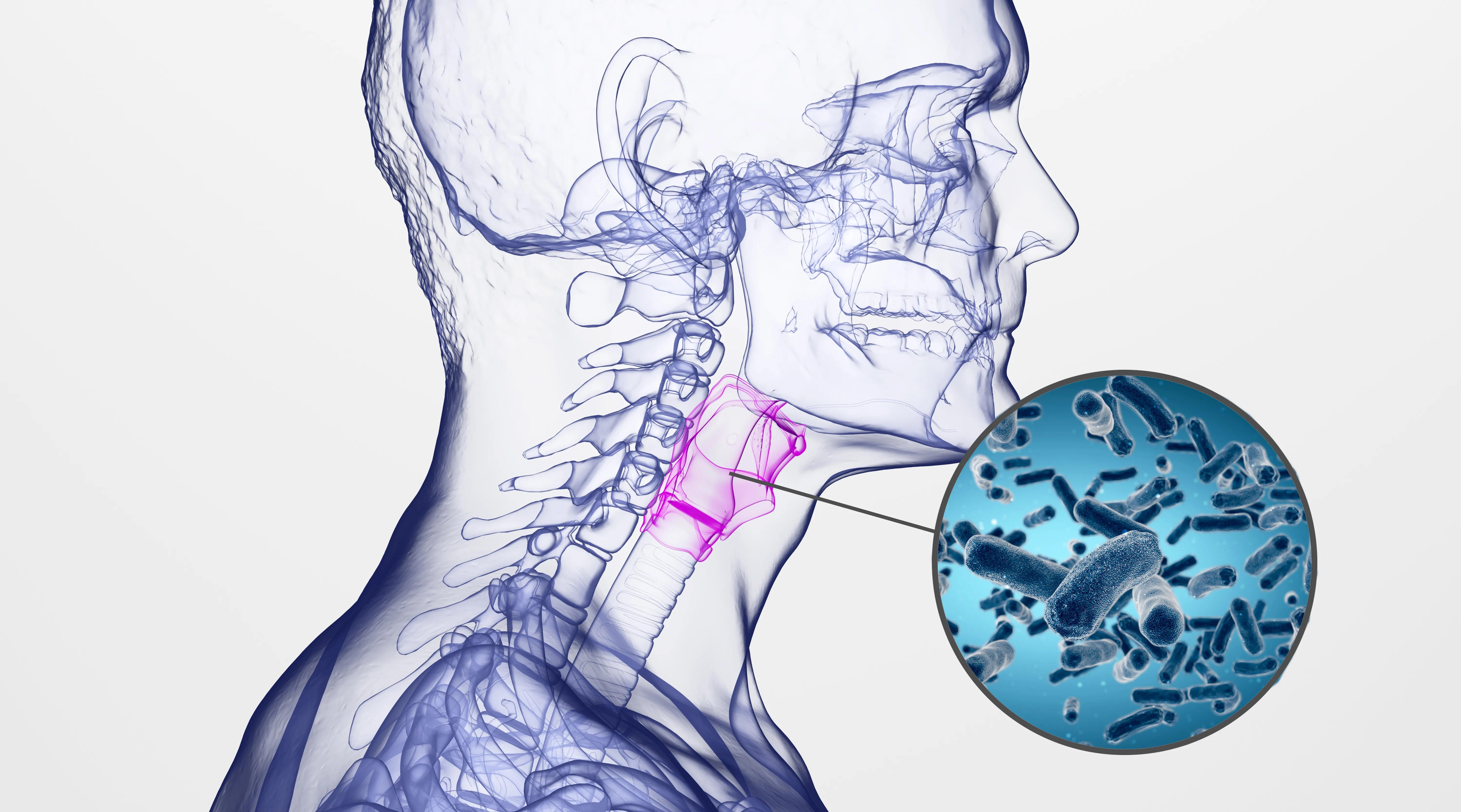 治疗各种慢性咽炎的药,如何治疗慢性咽炎用什么中药