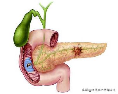 胰腺癌诊疗指南解读与实践,谈谈胰腺癌的症状有哪些呢