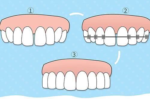 整牙齿就能变得很美,牙齿怎么整才能整成微笑牙