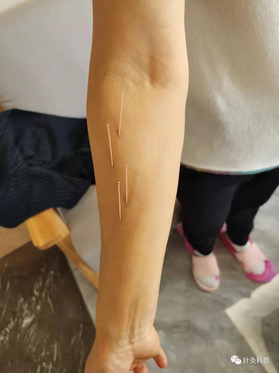 枕大神经痛应该针灸哪几个穴位,枕大神经痛针灸好吗