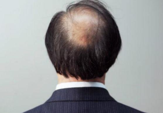 从脱发到毛囊坏死竟然这么快,去植发机构检查说毛囊萎缩脱发